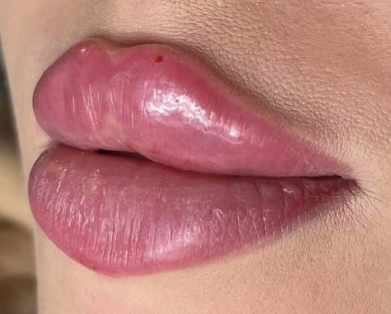 Fakten zu Hyaluron für Lippen