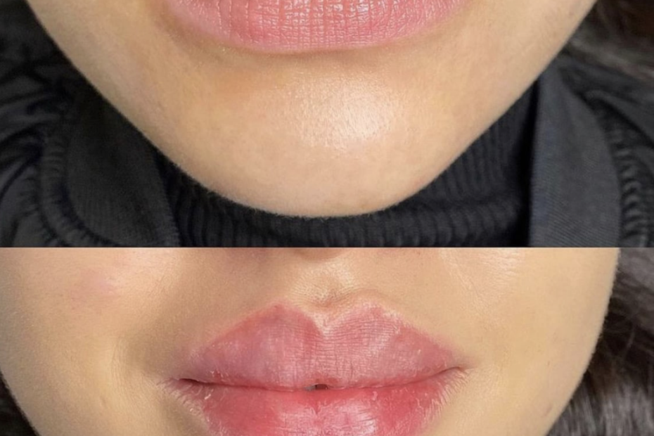 Lippen aufspritzen Vorher-Nachher
