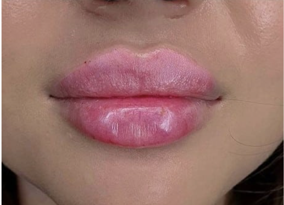 Lippenvolumen natürlich aufbauen