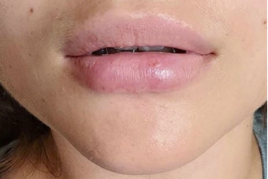 Nachsorge bei Lippenbehandlungen