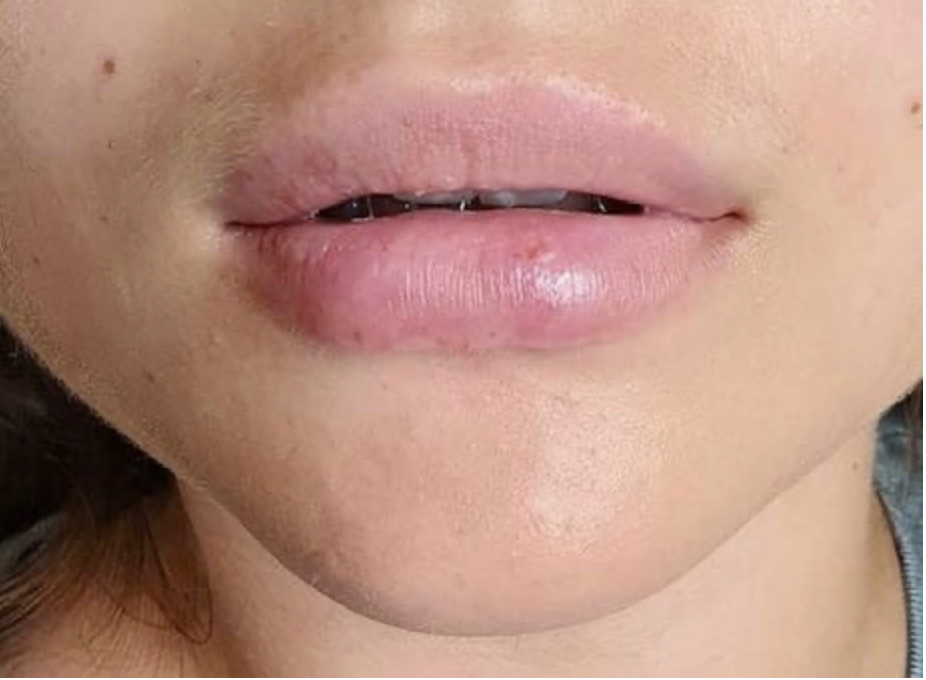 Nachsorge bei Lippenbehandlungen